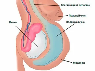 Tipuri de operațiuni pentru a elimina hidrocel