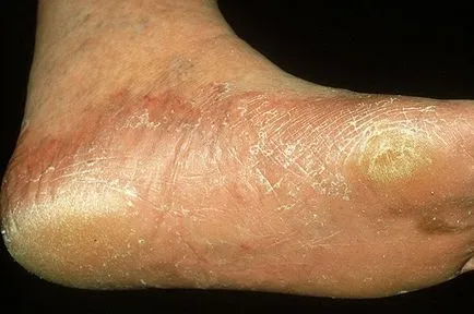 Típusú gombás betegségek a láb, különösen az áramlás, a fertőzés okát