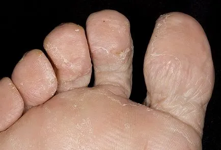Típusú gombás betegségek a láb, különösen az áramlás, a fertőzés okát