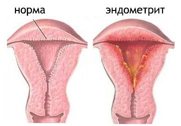 descărcare Apos la femei (cum ar fi apa) în cazul normei și patologie