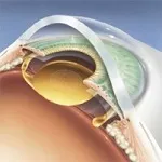 Вторични катаракта - най-ефективните лечения и опитни лекари, най-добрите условия и цена -