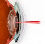 aftercataract