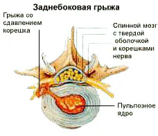 Задно диск херния (задно) - симптоми, лечение, диагностика, рехабилитация