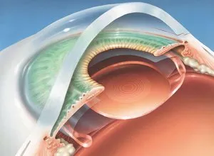 tratamente Keratoconus boala de ochi si costul de operare