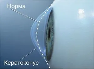 Кератоконус лечения на болести на очите и разходите за експлоатация