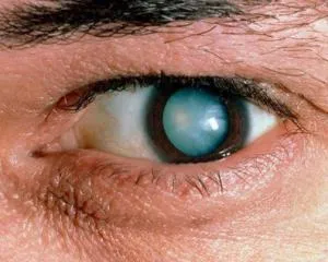 Cataract okai, tünetei, kezelése és megelőzése