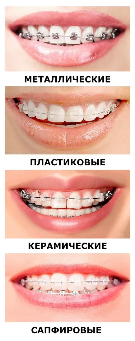 Керамични скоби - добър стоматология област София Виборг