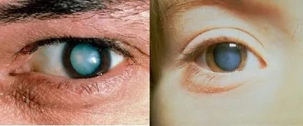 Cauzele cataractei, simptome, tratament si prevenire