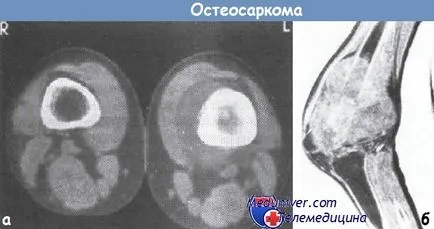 Clinica și diagnosticul de osteosarcom