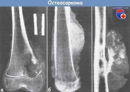 Клиника и диагностика на остеосарком