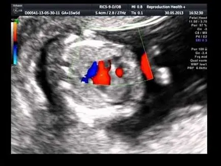 Cand vazut in inima fetale ultrasunete
