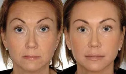 Conturarea de umplere din plastic de buze augmentare Restylane