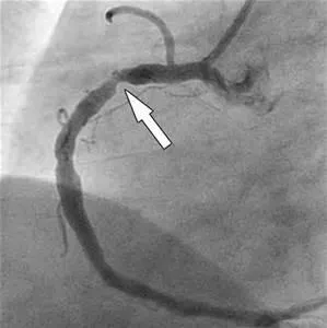 Коронарната ангиография и КТ на сърдечните съдове, компютъризирана многослойна томография на коронарните артерии