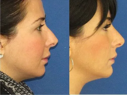 Корекция нос без операция намаляване и корекция на върха на носа чрез инжектиране и нишки