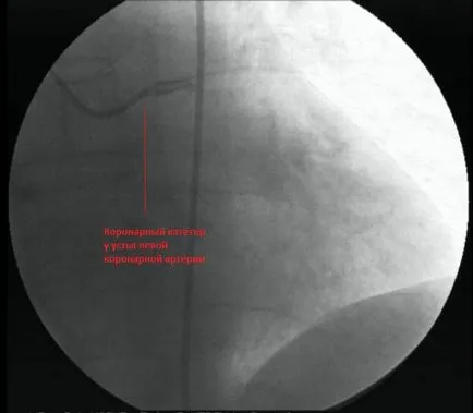 Angiografia coronariană - medicina bazata pe dovezi pentru toate