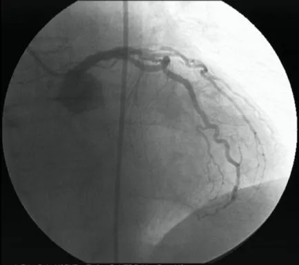 Angiografia coronariană - medicina bazata pe dovezi pentru toate