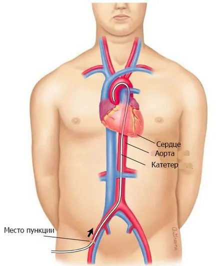 Angiografia coronariană - medicina bazata pe dovezi pentru toate