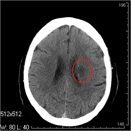 CT cerebral fără contrast