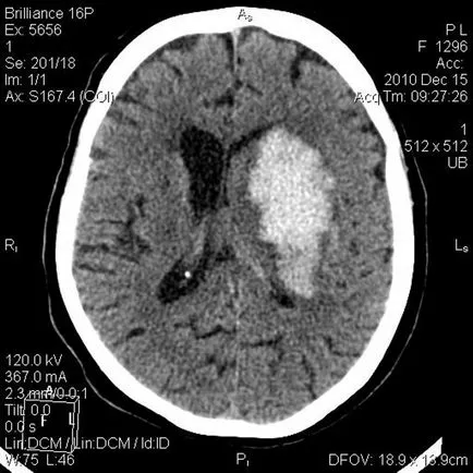 CT cerebral fără contrast