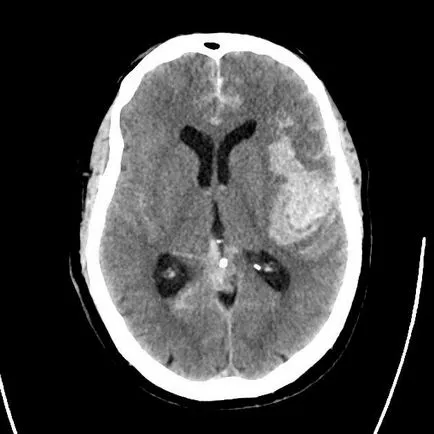 CT cerebral fără contrast