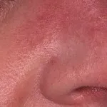 A kezelés szájon dermatitis, dermatitis