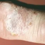 A kezelés szájon dermatitis, dermatitis