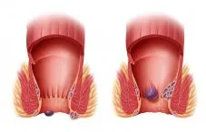 Хемороиди третиране с меден сулфат мнения лекар