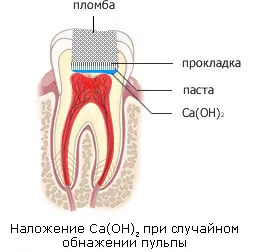 пулпит лечение, за лечение на пулпит Стоматология Зъболекарски цени в света