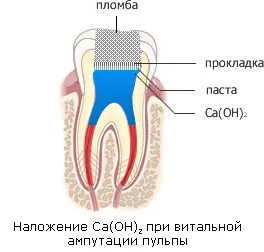 пулпит лечение, за лечение на пулпит Стоматология Зъболекарски цени в света