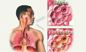 Kezelés A pulmonáris gyulladás használatával Badger zsírt