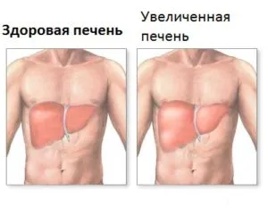 Лечение на симптоми на чернодробно хемангиоми, причинява, фолк, лекарства, хирургически