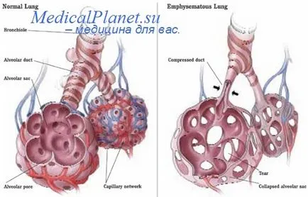 COPD kezelésére szanatóriumi