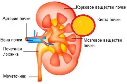 A vese kezelési ciszták népi jogorvoslati és receptek segítségével