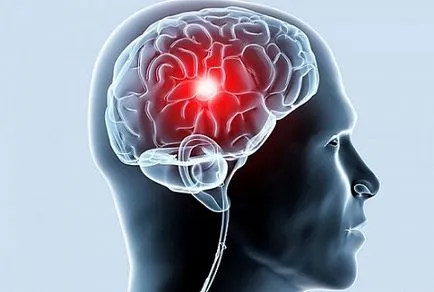 Tratamentul ischemiei terapiei de droguri cerebrală sau o intervenție chirurgicală