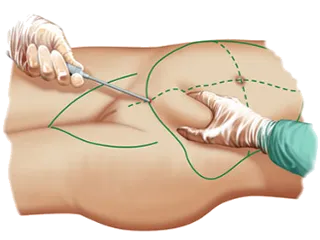Липосукция студен лазерни предимства на нехирургични лазер липосукция, признаци и