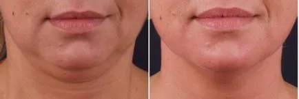 препарати за ефективност и резултати мезотерапия dermahil линия