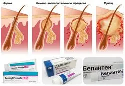 Unguentul de vindecare pentru zona intimă, antipruriginoasă, de inflamație, senzație de arsură