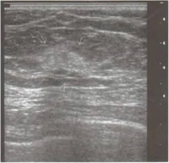 Breast - emlő ultrahang