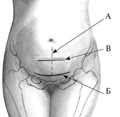 Uterul dupa semne cezariana si simptome de discrepanțe comune, posibile complicații