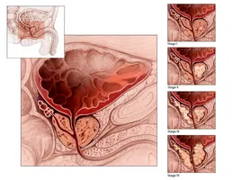 A kezelési módszerek a prostatitis ultrahang