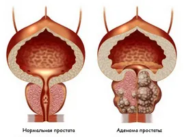 Metodele de tratament al prostatitei ultrasunete