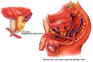 Metodele de tratament al prostatitei ultrasunete