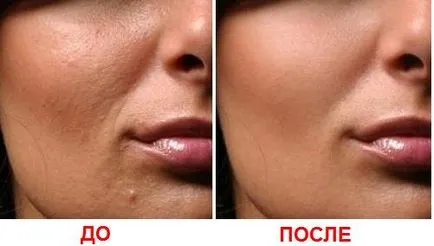 Mezoterapia dermahilom comentarii cosmetologi, eficiență