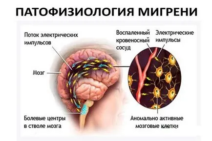 Мигрена причини, симптоми, лечение и профилактика