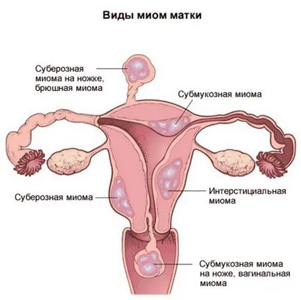 Миома на матката симптоми и лечение, MRI диагностика на миома на матката