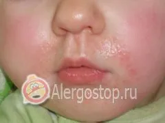 Latex allergia a gyermek - gyermek allergia