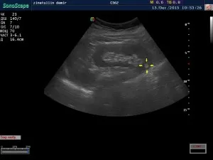 Angiomyolipoma на бъбрек 1