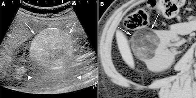 бъбречна angiomyolipoma