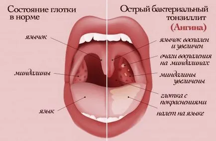 Ангина симптоми и лечение на хората в дома, дом здраве