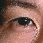 Blepharitis besorolás, diagnózis, tünetek, kezelés